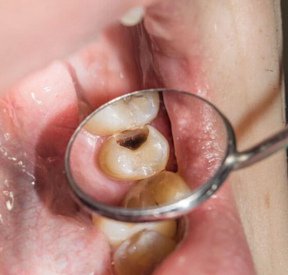 Close-up of tooth with cavity and decay examined with dental mirror during examination.