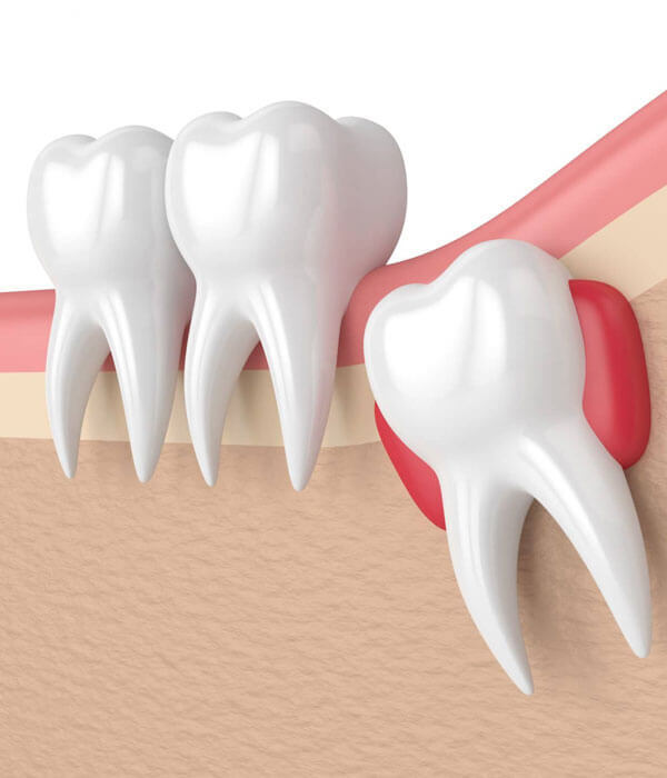 Illustration of wisdom tooth extraction showing impacted tooth removal from jawbone with healthy teeth nearby.
