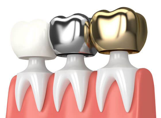 Three dental crowns in white, silver, and gold displayed on a gum model.