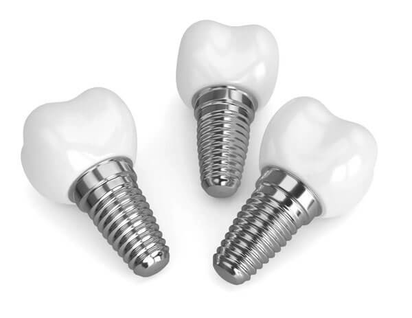 Three dental implants with metal titanium posts and white ceramic crowns.