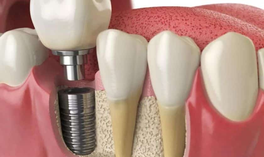 Featured image for “Dental Implants: How Long Will They Last?”