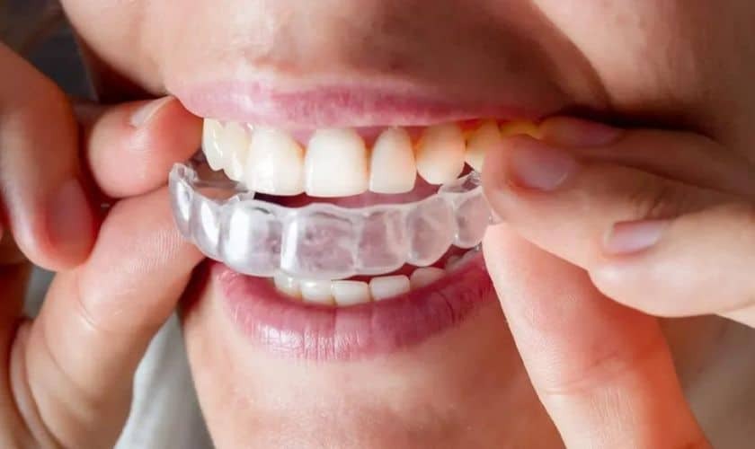 Featured image for “What is the Significance of Invisalign for Overbite patients”