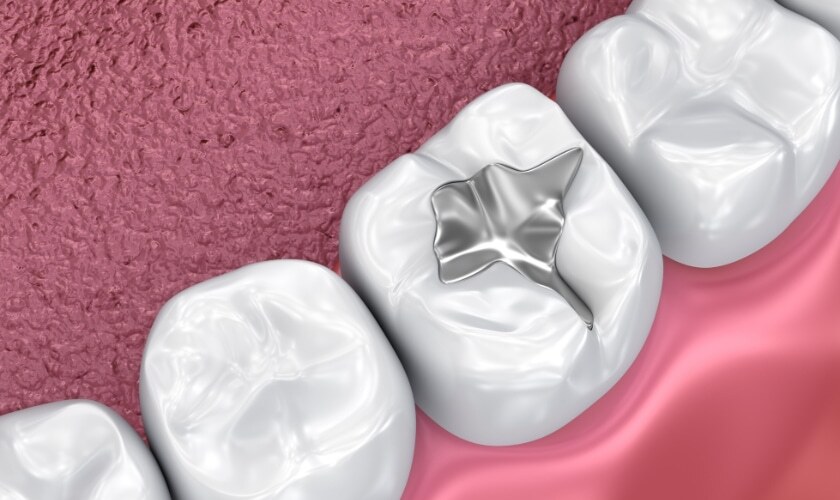 Featured image for “Seal the Deal on a Cavity-Free Future: The Essential Guide to Dental Sealants”