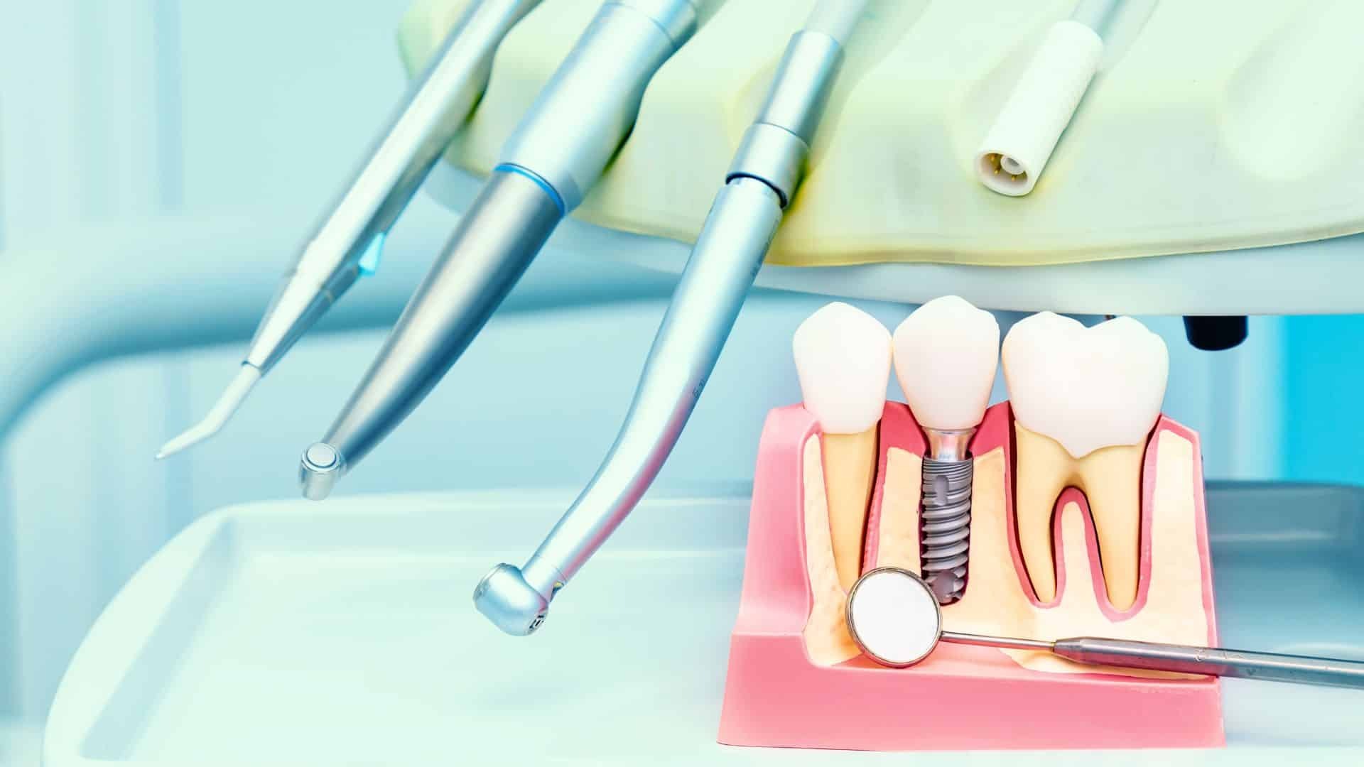 Featured image for “How To Choose The Right Dental Implant Specialist”