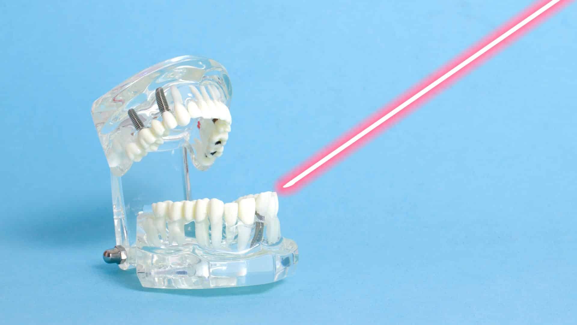 Featured image for “How Laser Dentistry is Revolutionizing Modern Dental Care”
