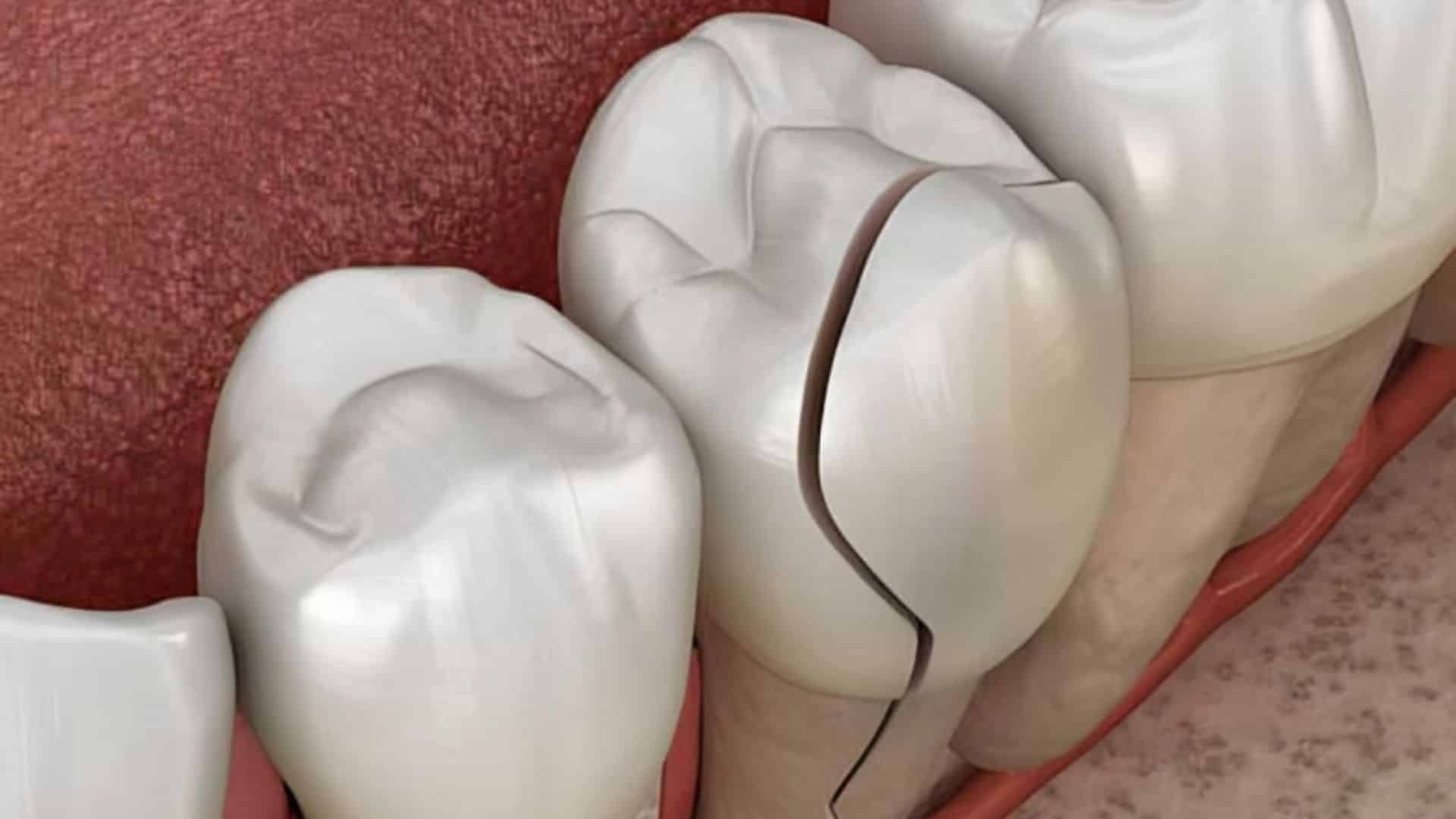 Featured image for “When Cracked Teeth Can Become a Serious Dental Emergency”