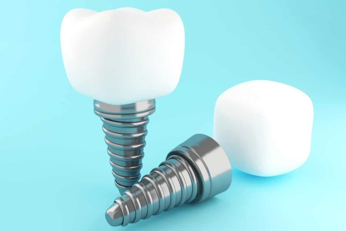 Featured image for “Are Dental Implants Necessary for Molars?”