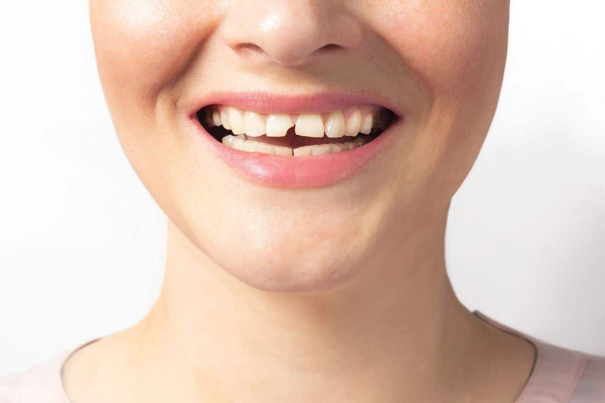 Featured image for “Dental Restoration Options For Broken Or Cracked Tooth”