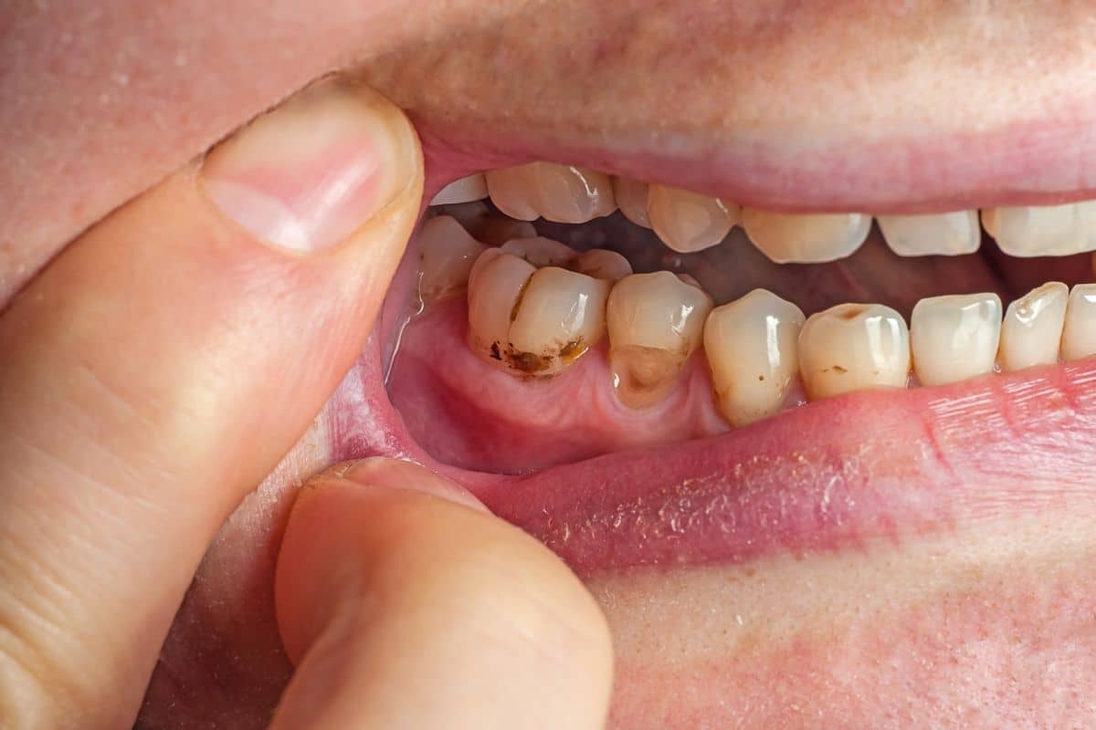 Featured image for “What is Gumline Cavity? Causes and Symptoms”