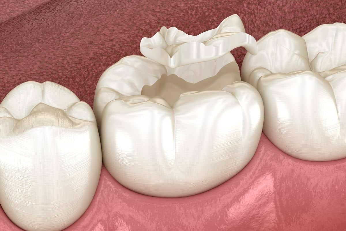 Featured image for “Are Dental Sealants On Molars Necessary?”
