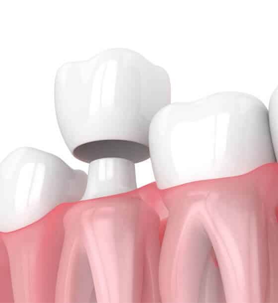 Dental Crown in Portland