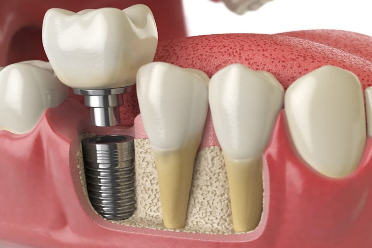 Featured image for “Is A Loose Dental Implant An Emergency?”