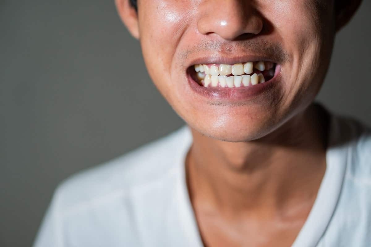 Featured image for “Say Goodbye to Tetracycline Stains: Effective Treatments for a Brighter Smile”