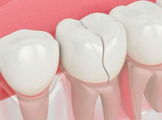 Cracked tooth illustration showing damage between two healthy teeth on pink background.
