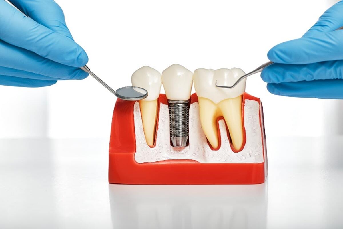 Featured image for “Why More Portland Residents Are Choosing Dental Implants Over Dentures?”