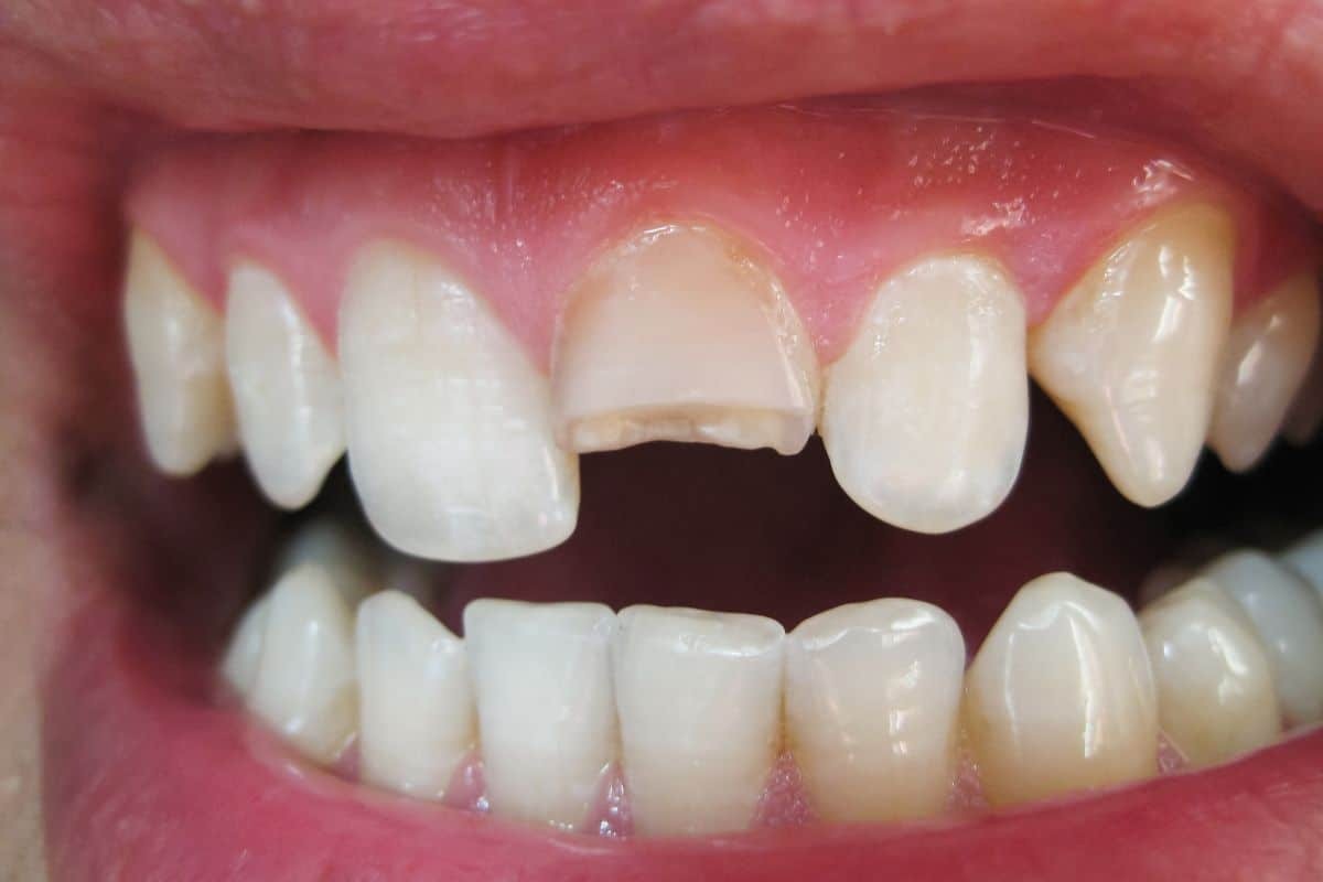 Featured image for “How to Fix Chipped, Gapped, or Uneven Teeth Without Braces”