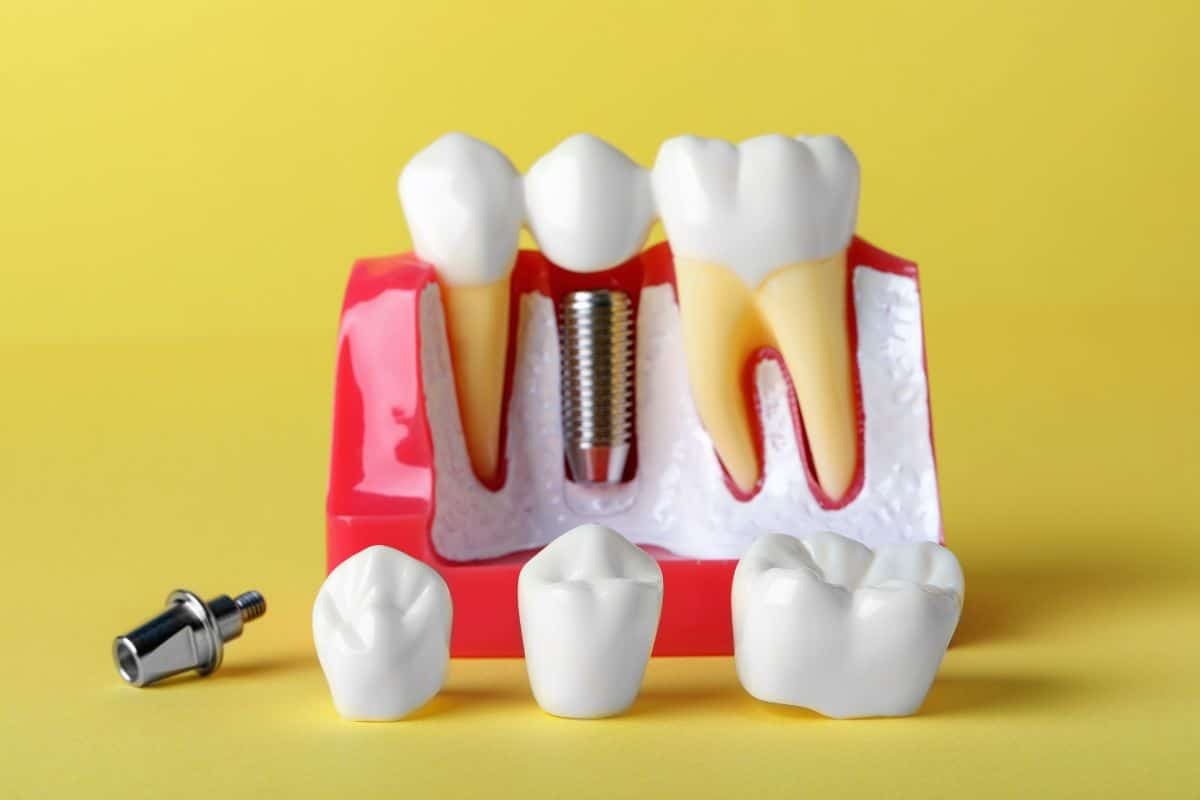 Featured image for “Is a Bone Graft Necessary Before Your Dental Implant Procedure?”