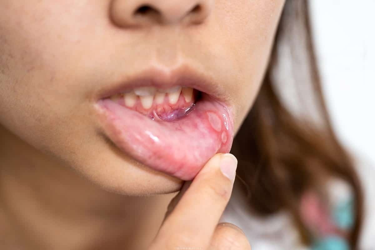 Featured image for “Can You Go To The Dentist With A Cold Sore?”