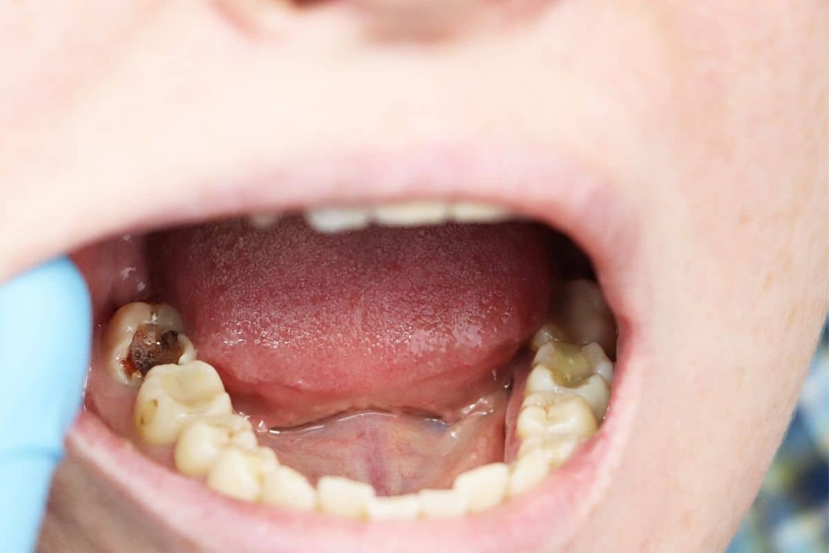 Featured image for “How To Heal Cavities In 2 Days At Home”