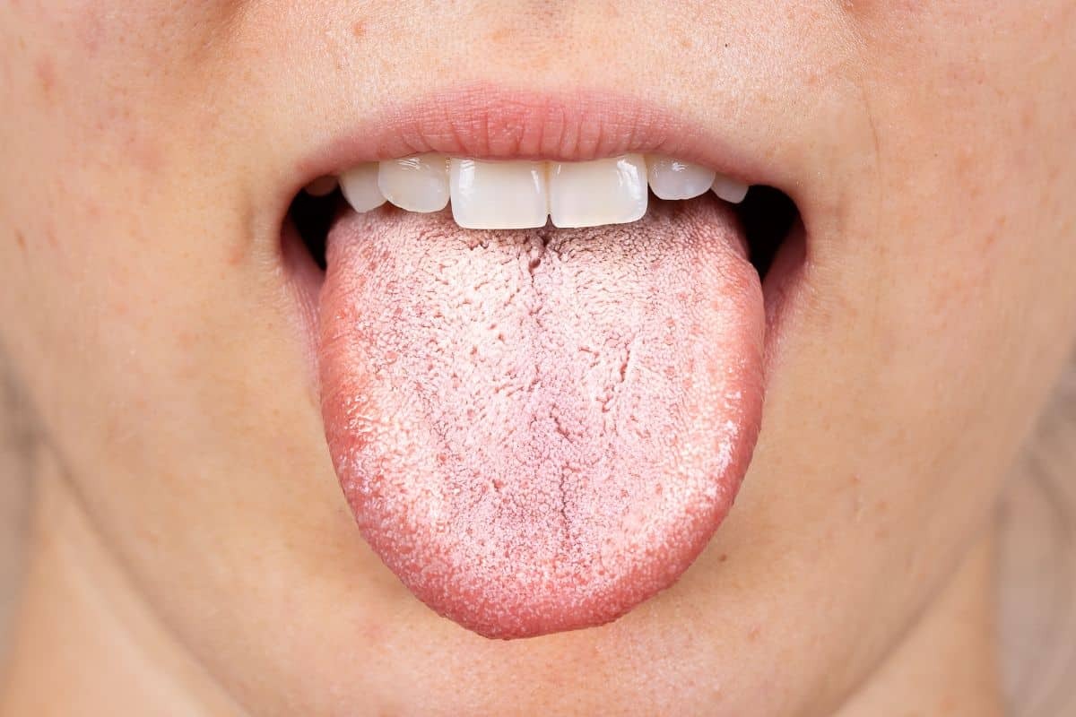 Featured image for “Why Is My Tongue White? Causes, Symptoms, and Treatments”