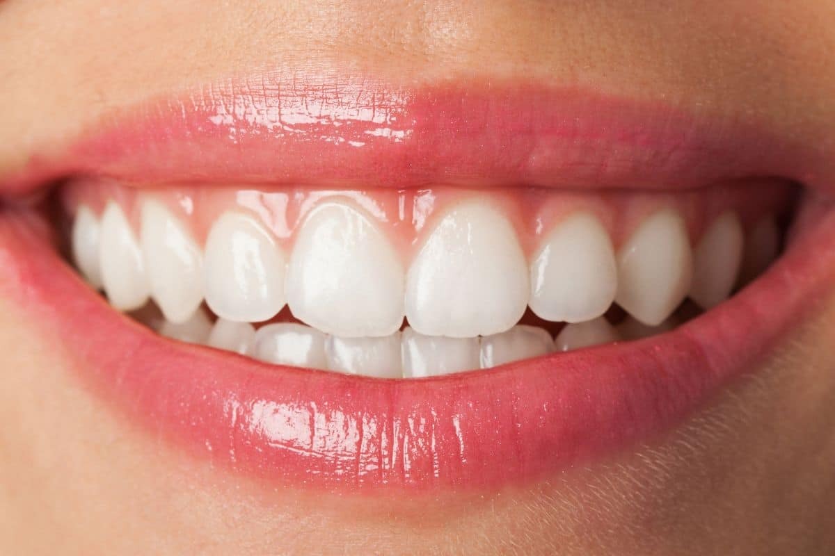 Featured image for “Craze Lines in Teeth: Causes, Symptoms, and Treatment Options”