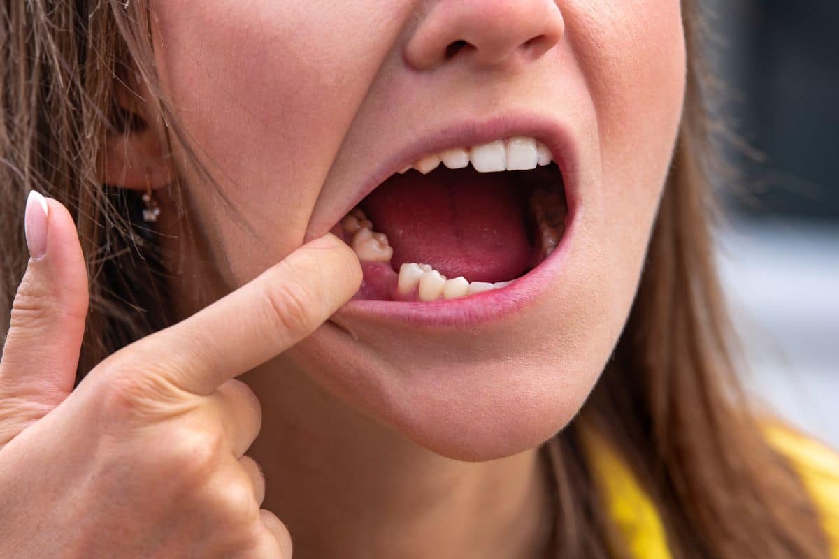 Featured image for “What Happens to Your Jawbone When You Lose a Tooth?”